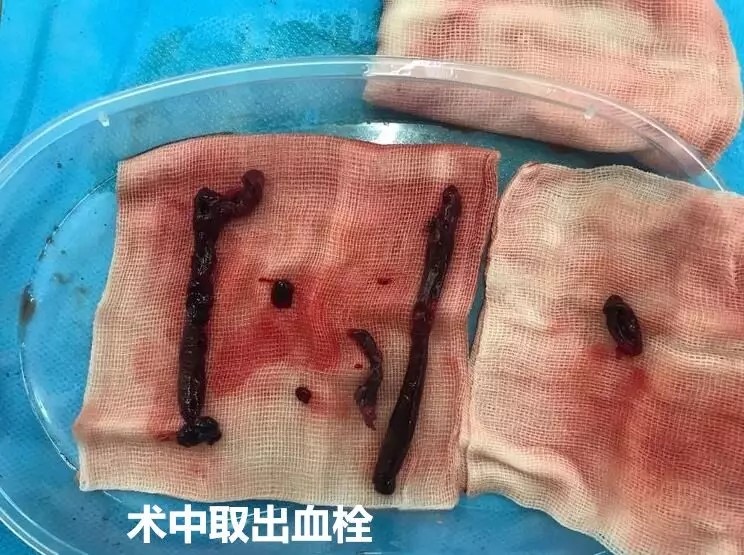 最新取血栓技术，时代进步的产物与守护健康的先锋